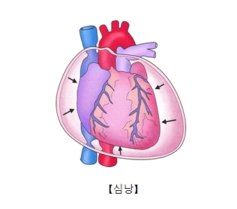 심낭염