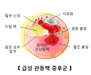 급성 관동맥 증후군