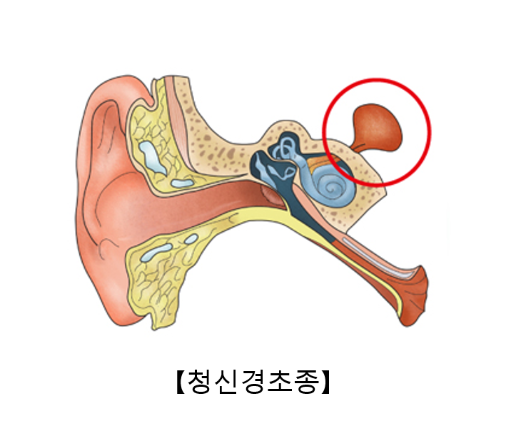 청신경종