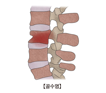 골수염