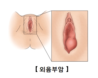 외음부암