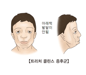 트리처 콜린스 증후군