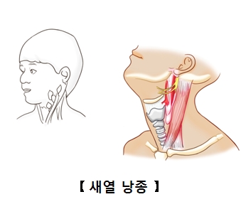 새열 낭종