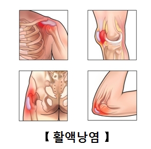 점액낭염