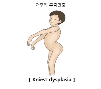 Kniest dysplasia