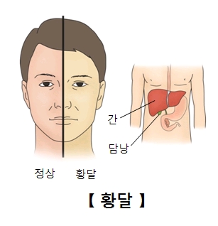 클라츠킨 종양