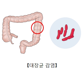 장출혈성 대장균감염증