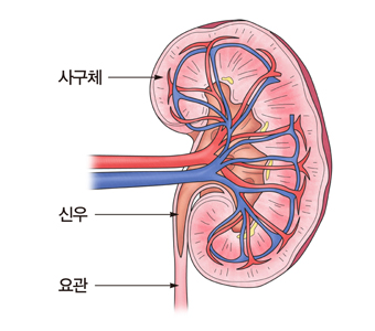 신세포 암종