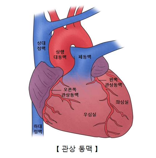 허혈성 심질환