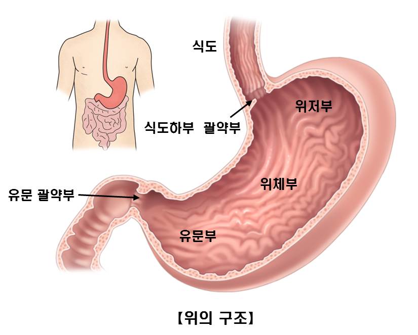 만성 위염