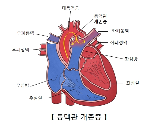 동맥관개존증