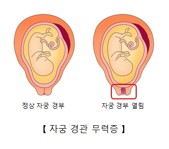 자궁경관무력증