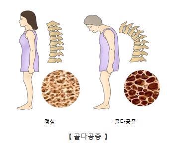 골다공증