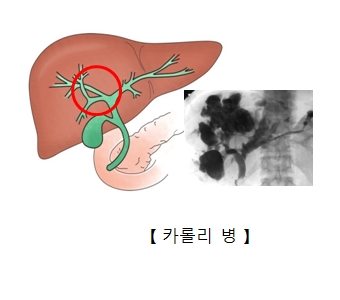 카롤리병