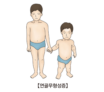 연골무형성증