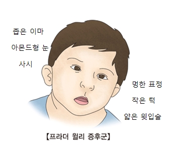 프라더 윌리 증후군