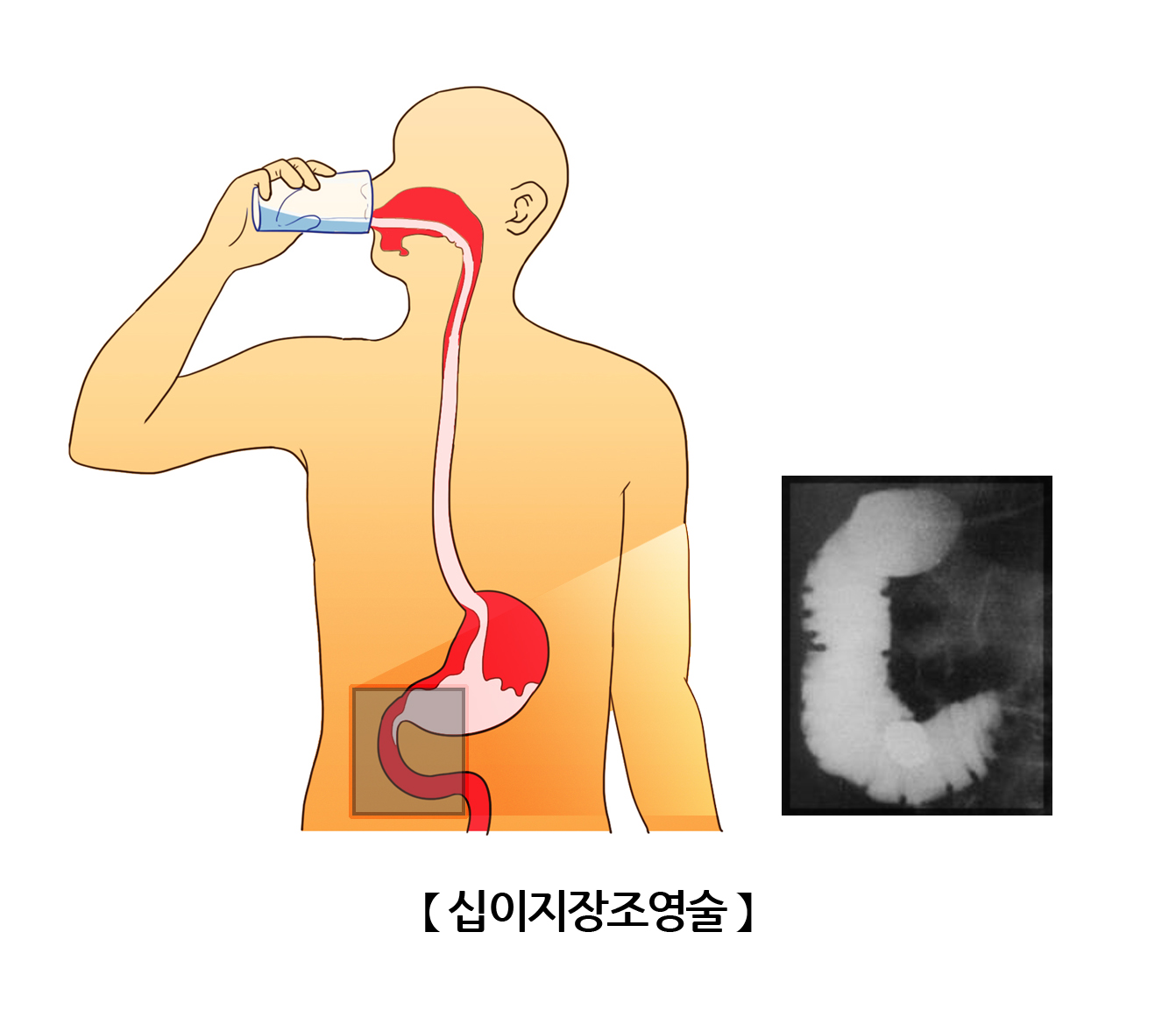 십이지장조영술