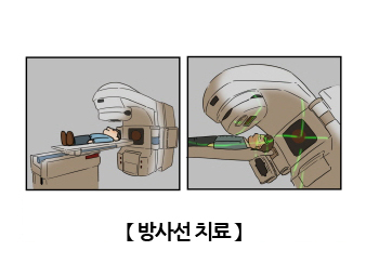 방사선치료