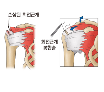 회전근개